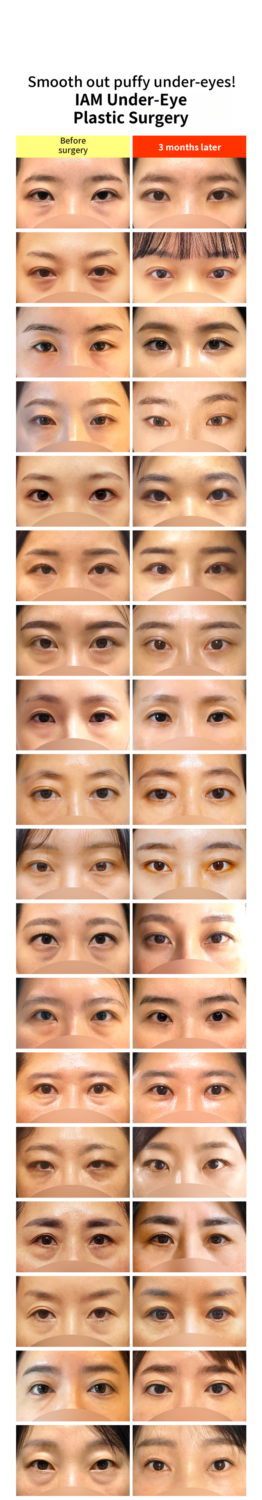 Busan I.M. Under-Eye Fat Relocation & Mid-Age Lower Blepharoplasty