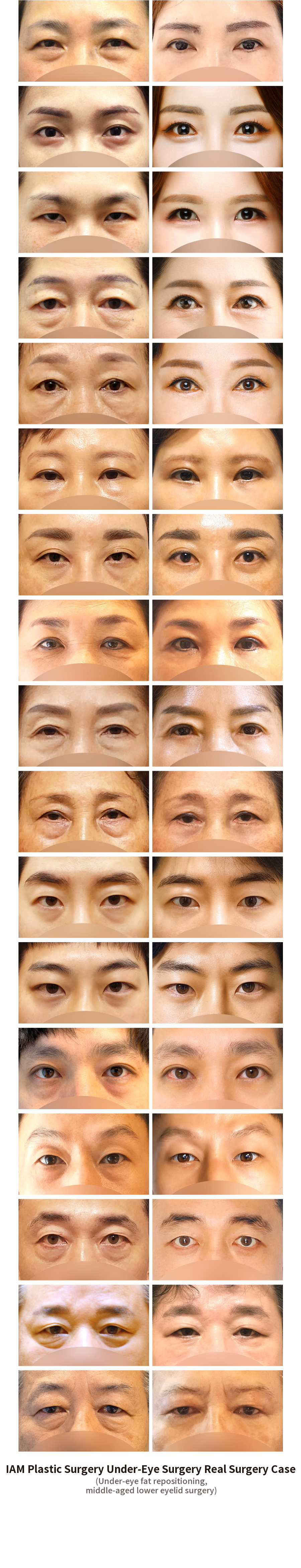 Busan I.M. Under-Eye Fat Relocation & Mid-Age Lower Blepharoplasty