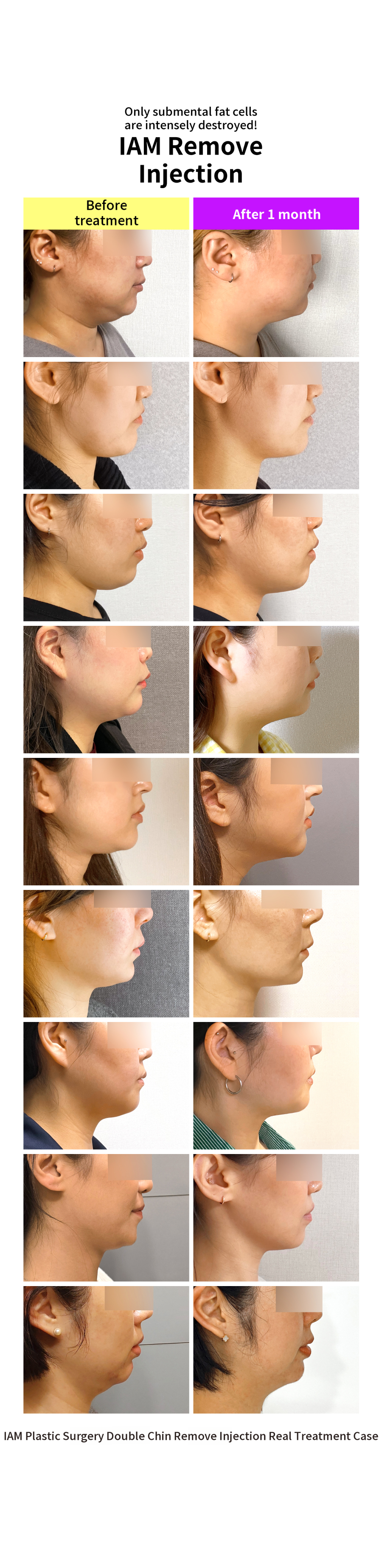 I AM Double Chin Fat Dissolution All-Out Injection & Submental Fat Injection