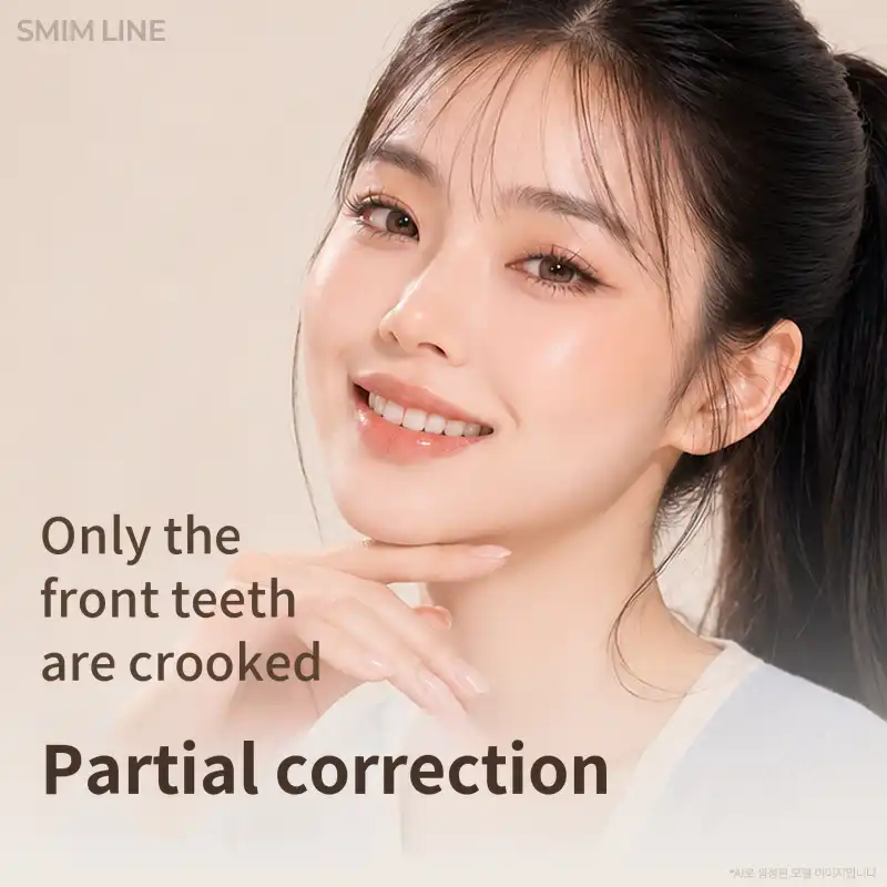 MiniFit Rapid Correction - Persistent Fast Alignment of Front Teeth