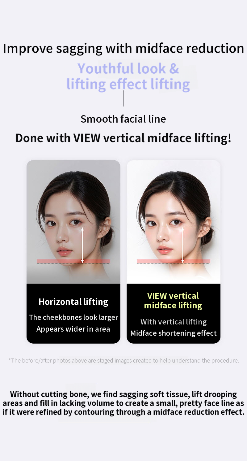 ❤View❤ Vertical Midface Lifting