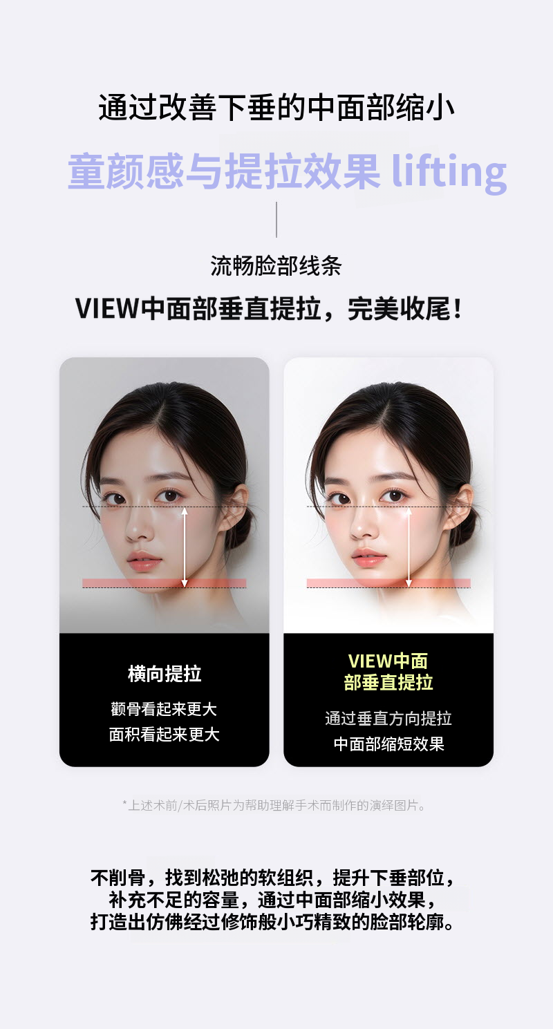 ❤视线❤中面垂直提升