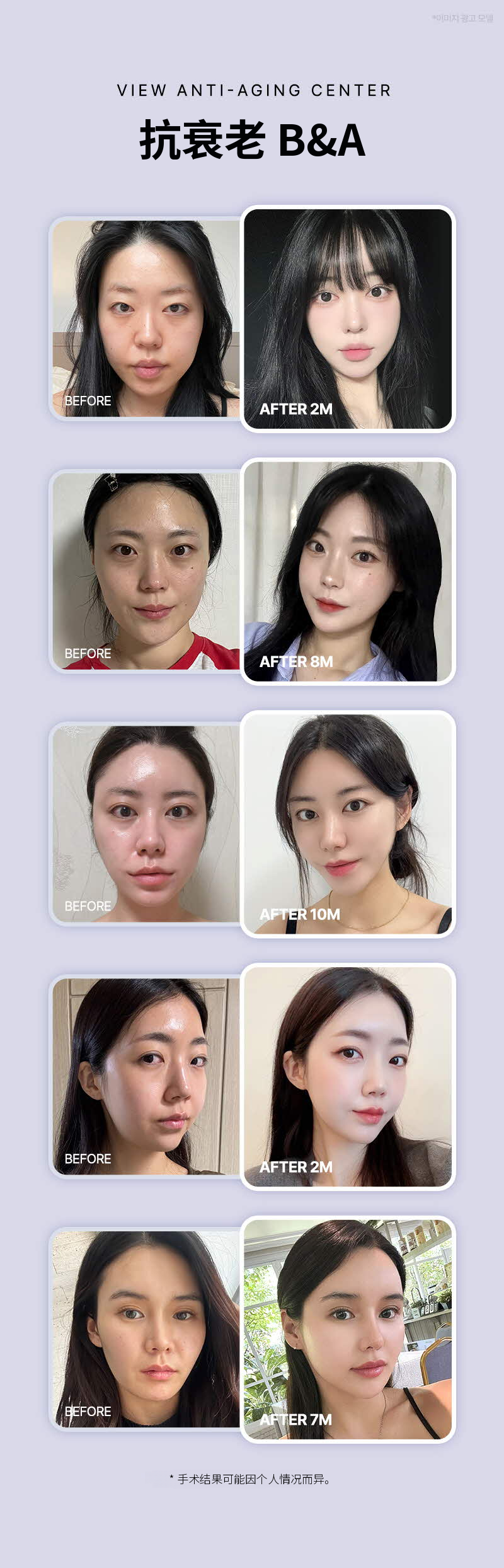 ❤视线❤中面垂直提升