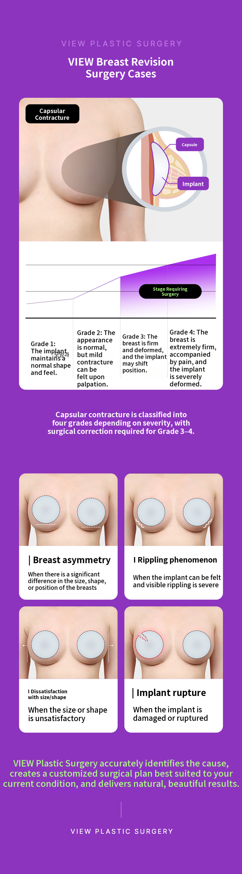 ❤View❤ Breast Revision Surgery