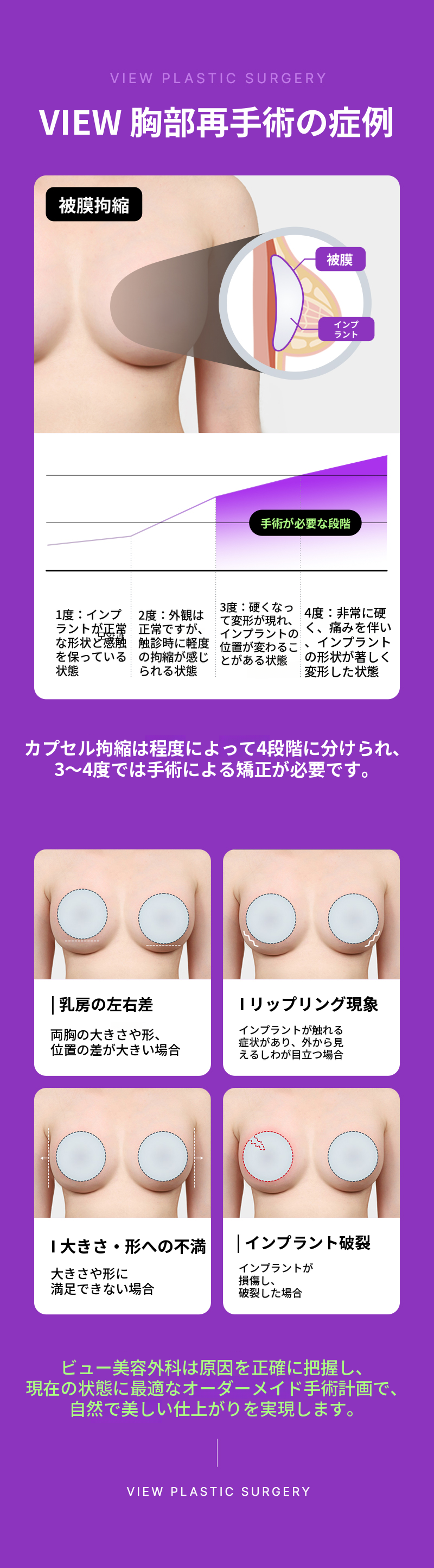 ❤ビュー❤豊胸再手術