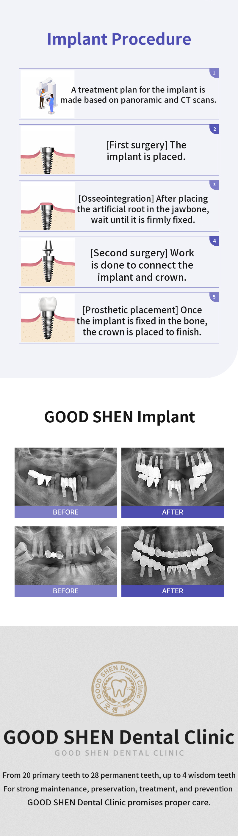 GoodSense Dio Implant
