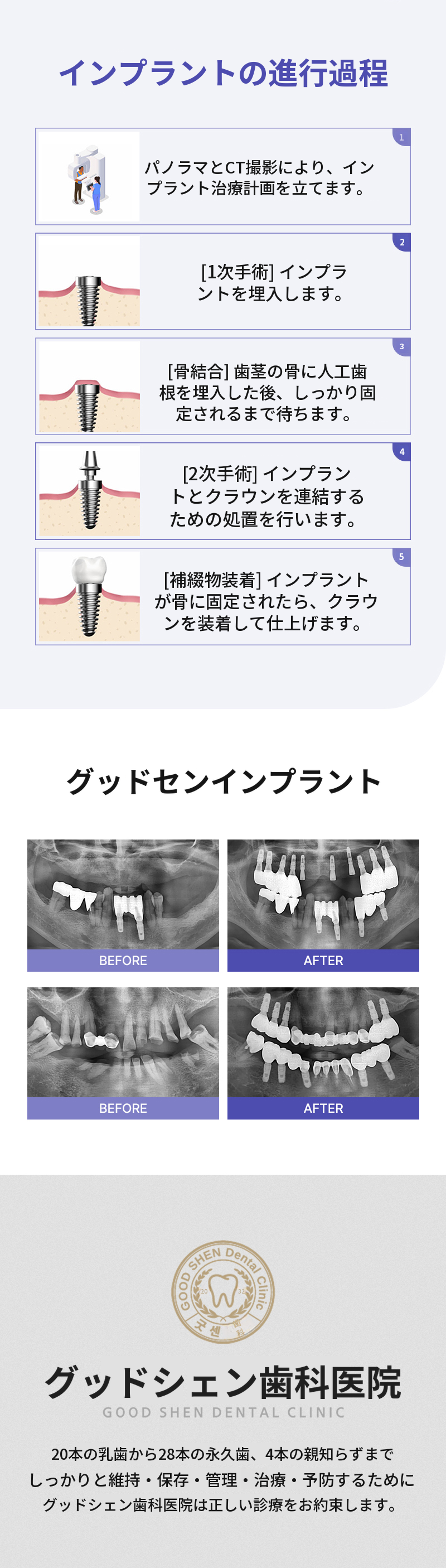 グッドセンインプラント
