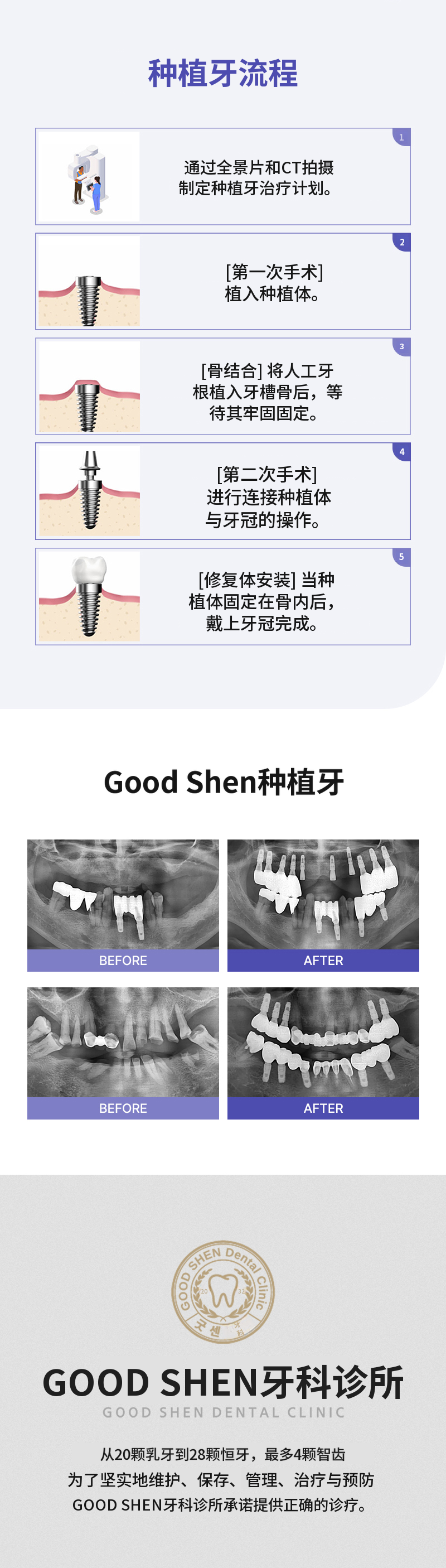 Goodson DIAM Implant