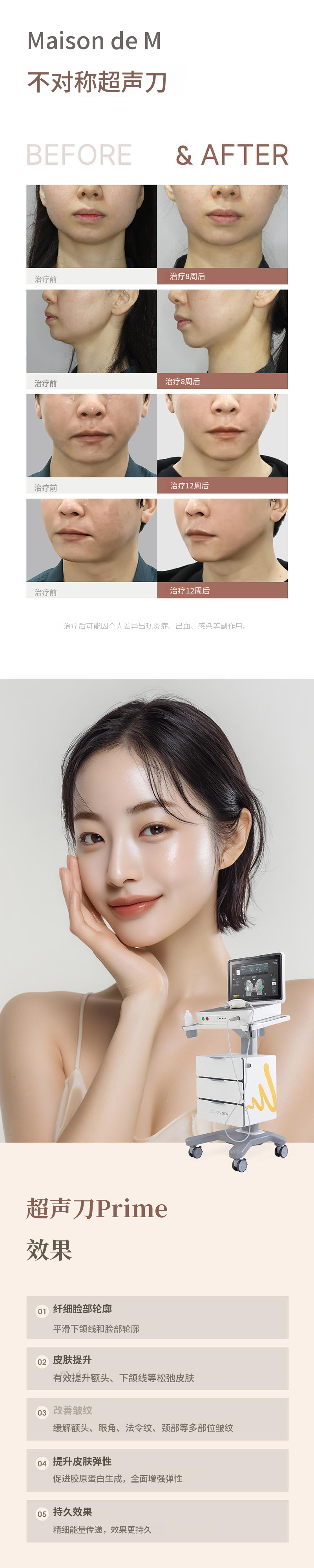 Ultherapy Prime