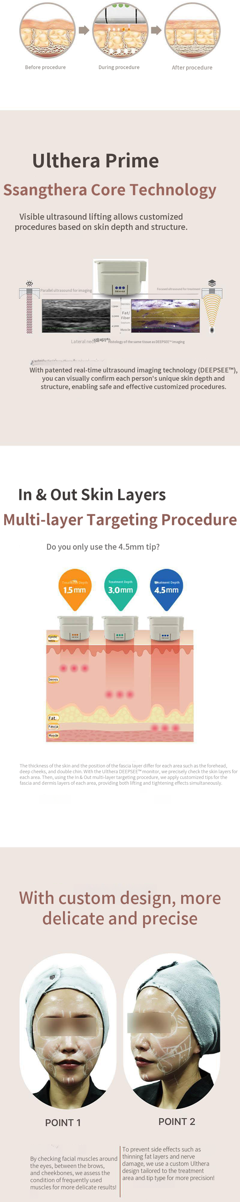 Ultherapy Prime Dual Treatment