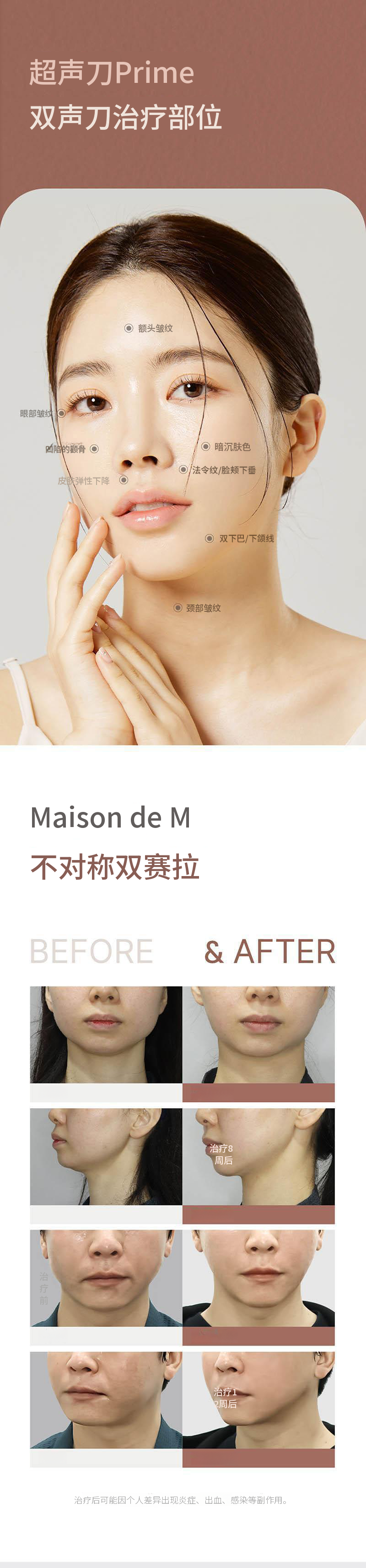 Ultherapy Prime双重提升