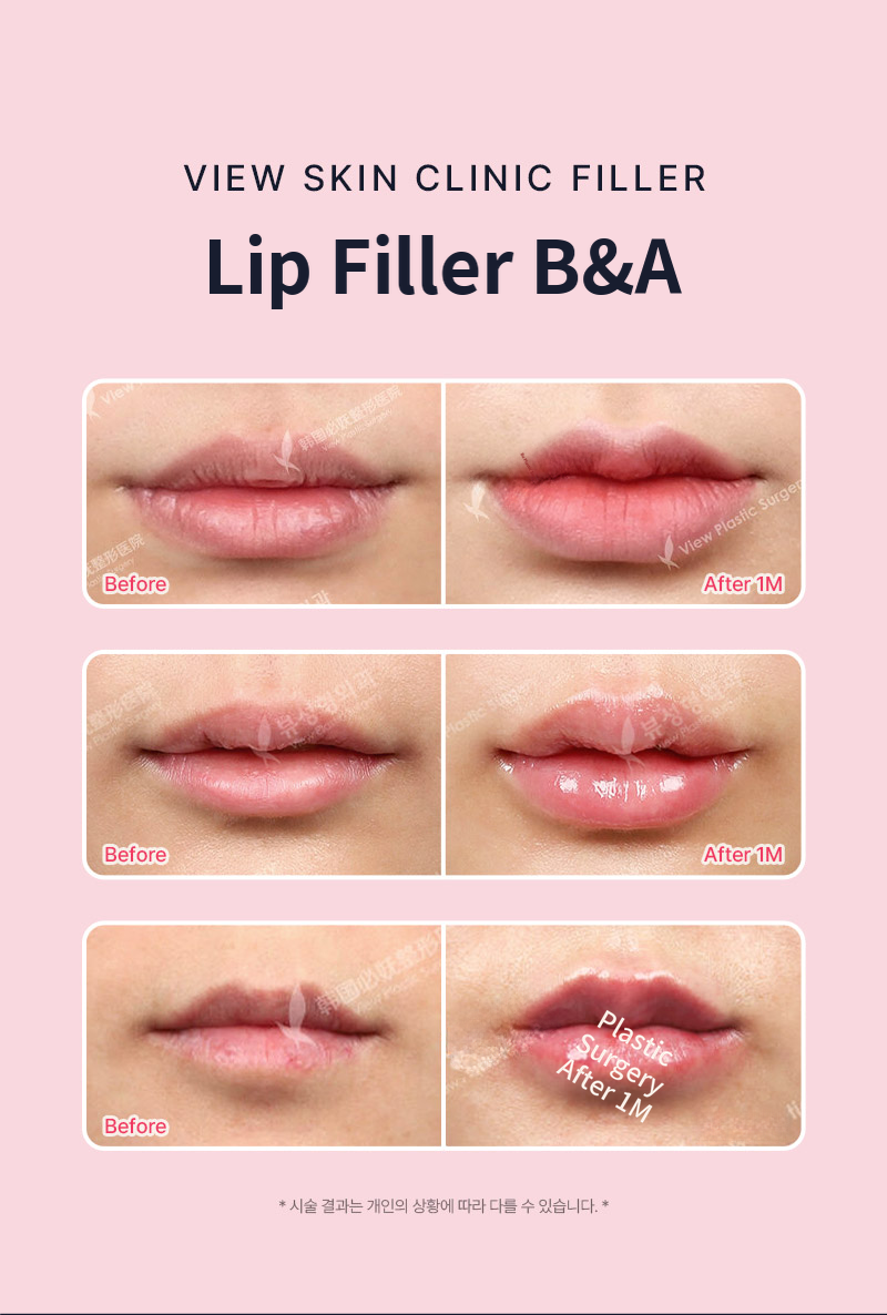 ❤View❤Restylane Lip Filler, Lip Corner Filler