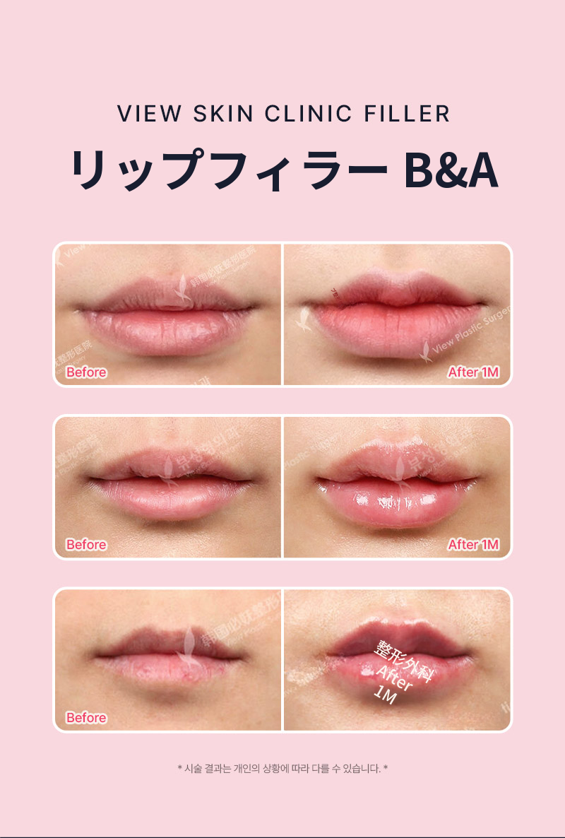 ❤ビュ❤レスタレーンリップフィラー、口角フィラー