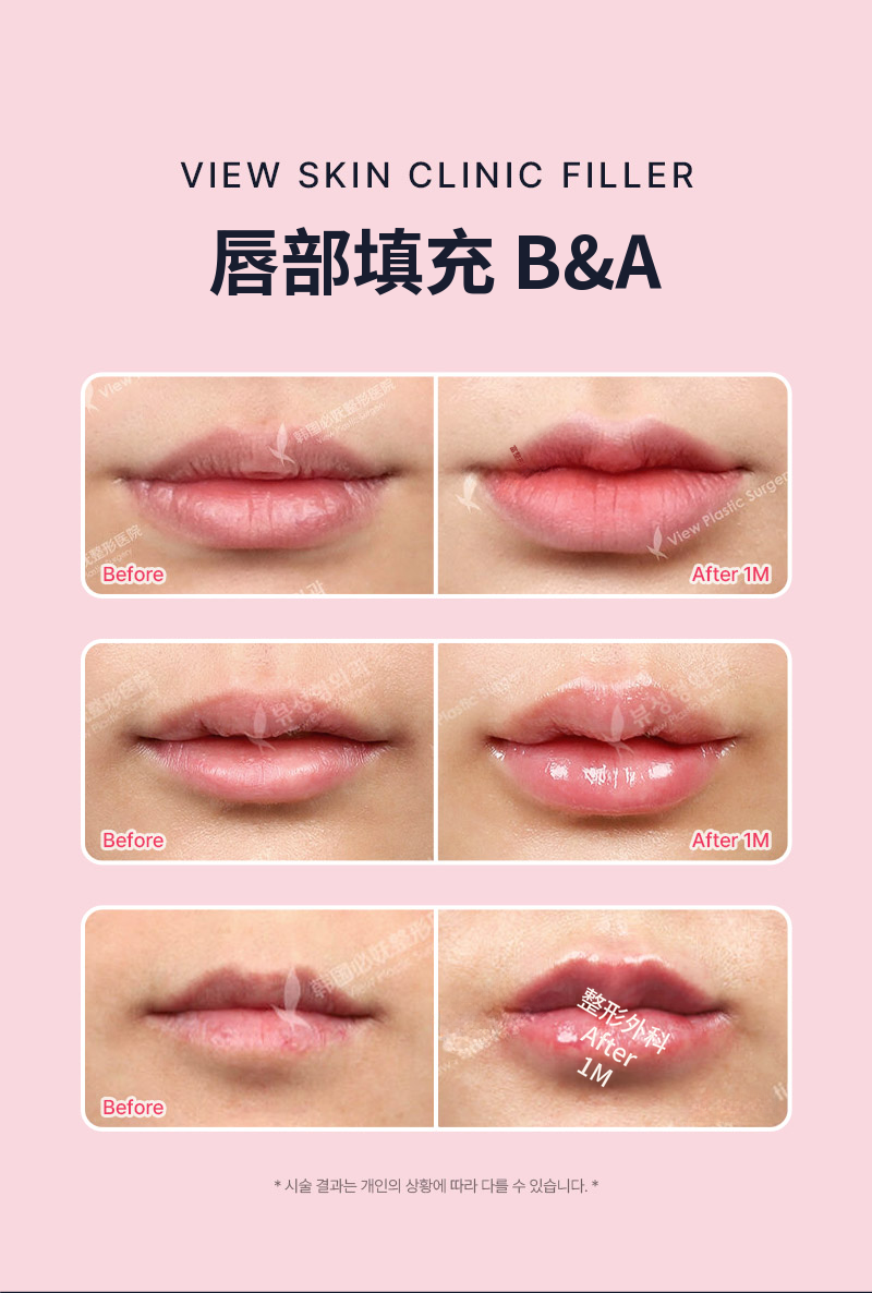 ❤视❤瑞士玻尿酸唇部填充剂, 口角填充剂