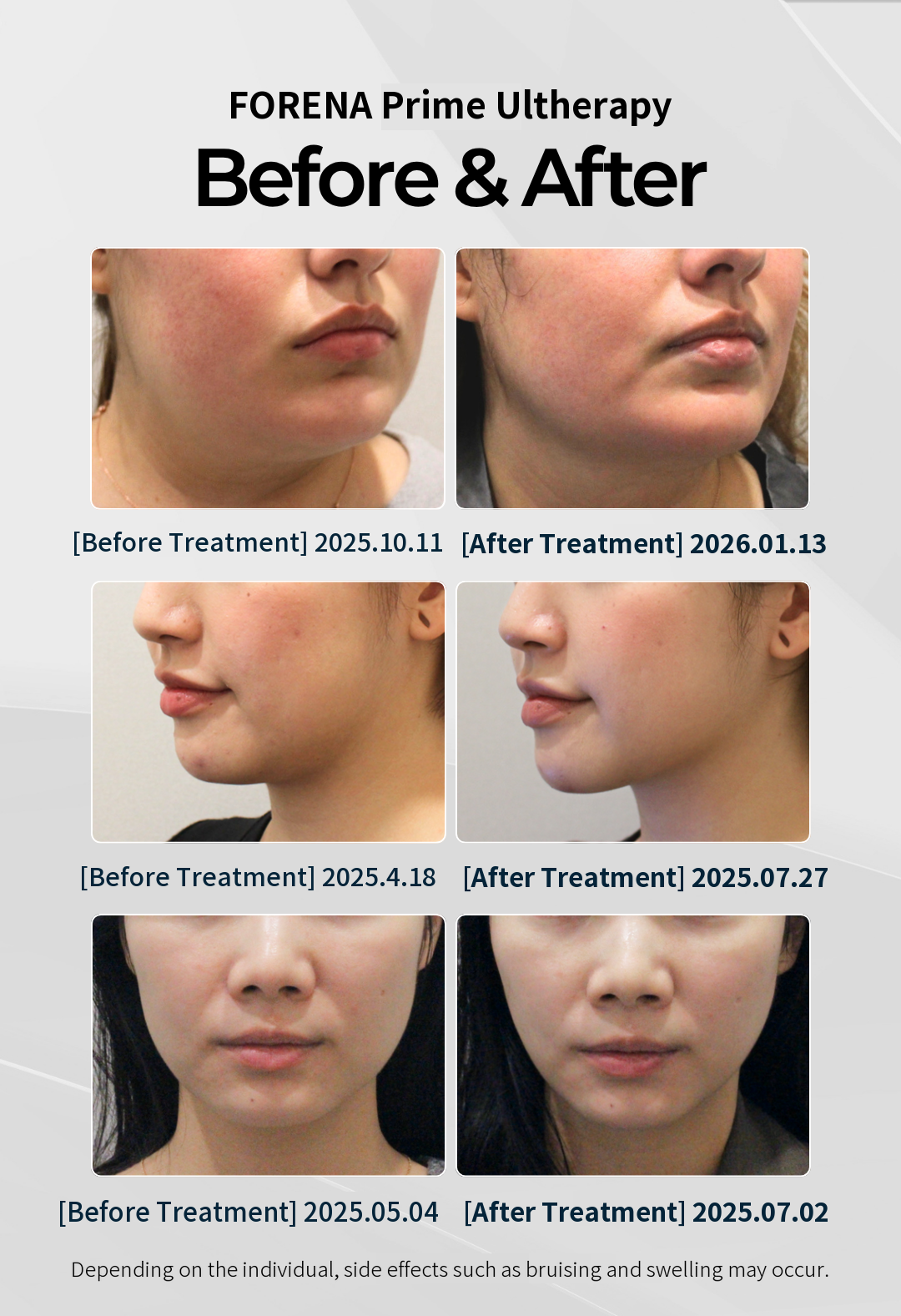 Hondae Station Ultherapy Prime