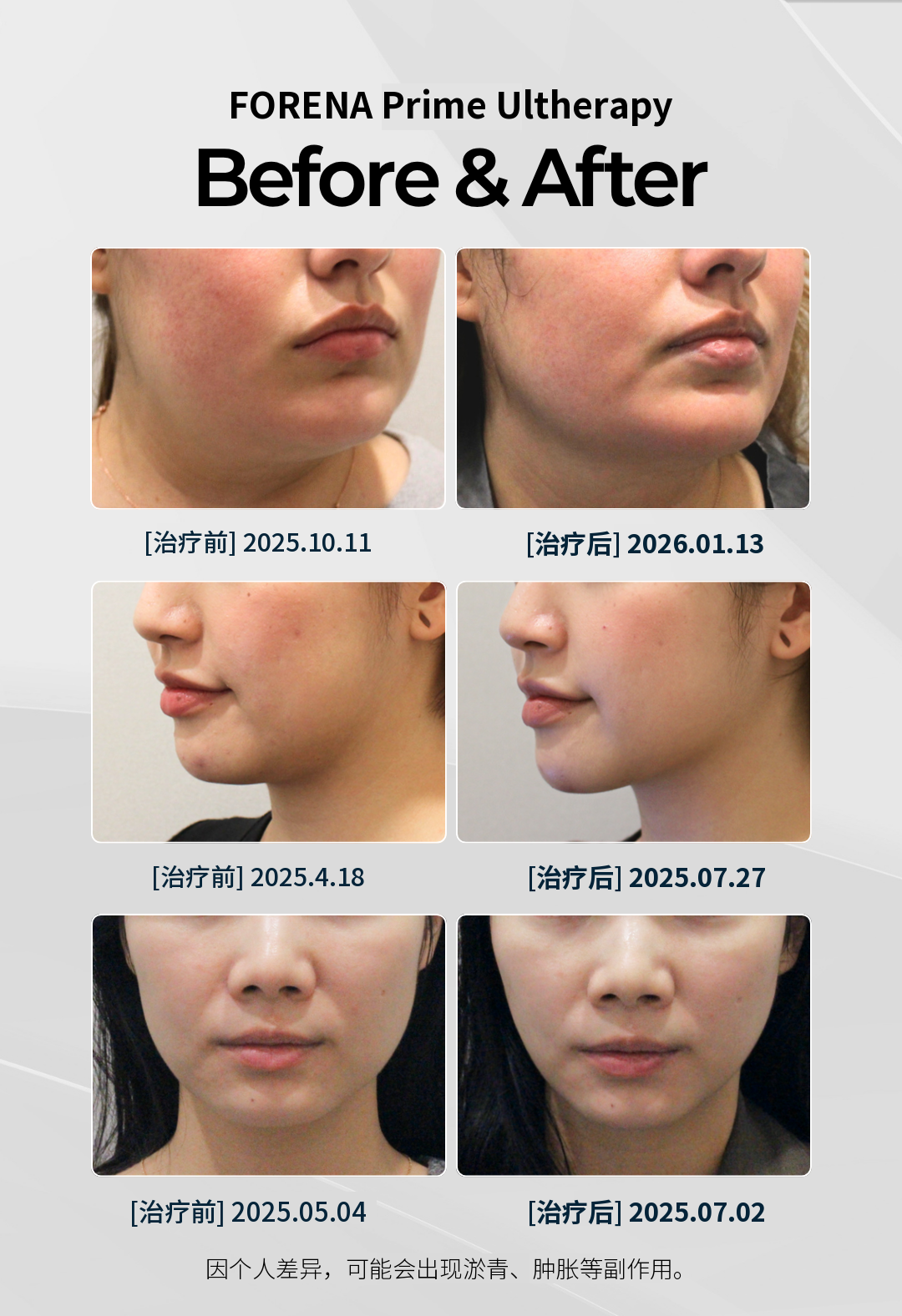 弘大入口站超声刀(Ultherapy)优选