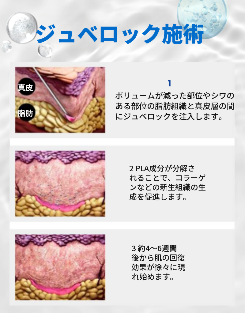 オルピチャジュベルック、ジュベルックボリューム、ジュベルックアイ