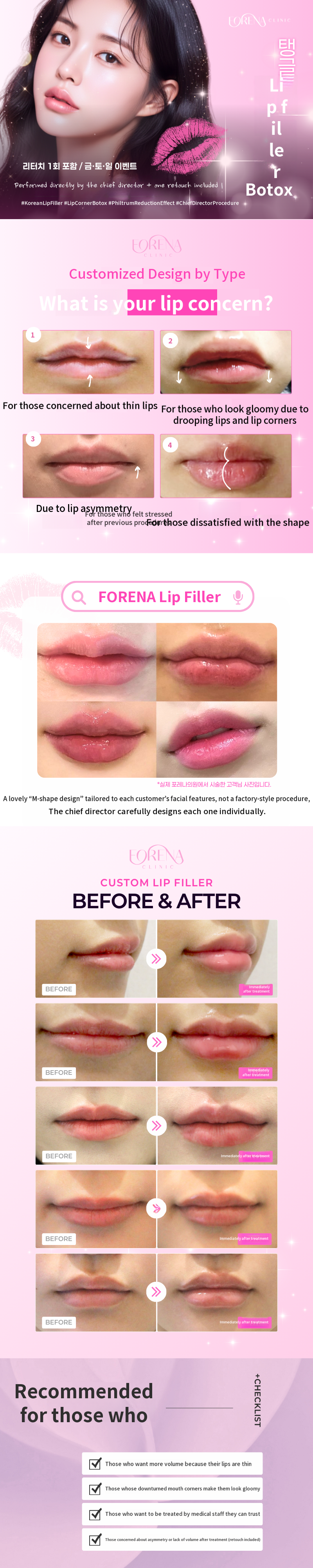 Lip filler + corner of the lips Botox [1 session retouch]