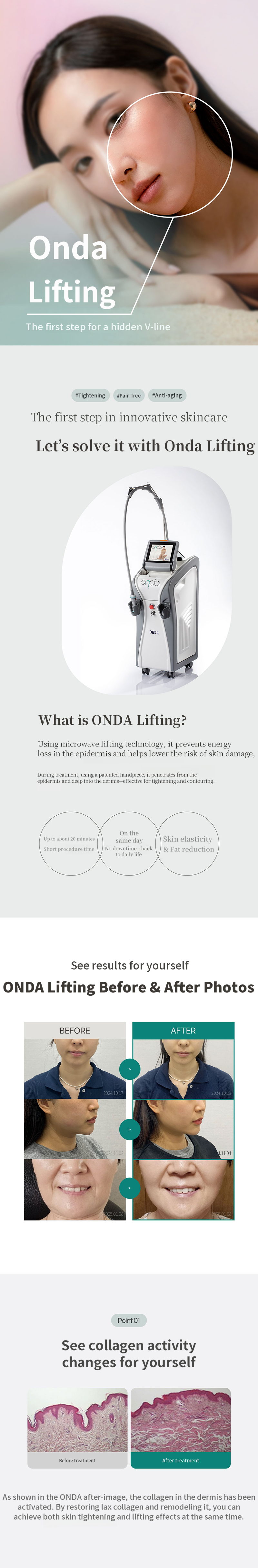 Ondari lifting 60KJ