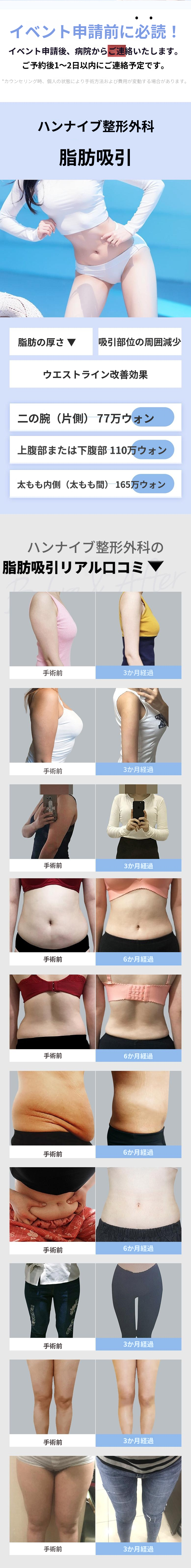 大容量ハンドメイドボディ脂肪吸引