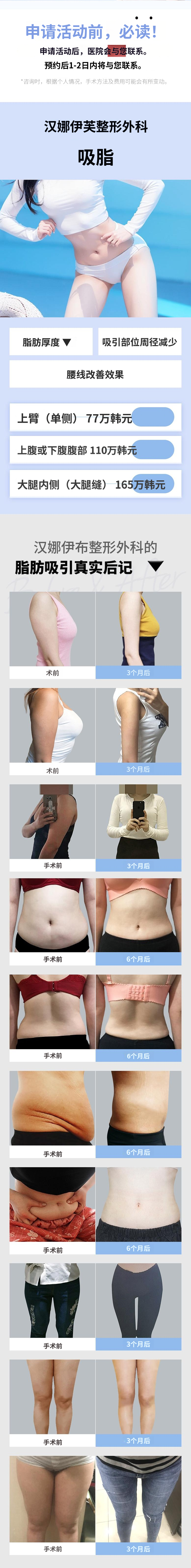 大容量手工身体抽脂