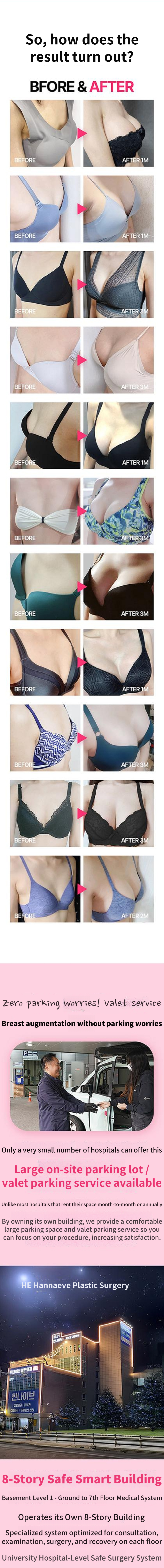 Hannaive Real Admiration Breast Surgery Breast Augmentation