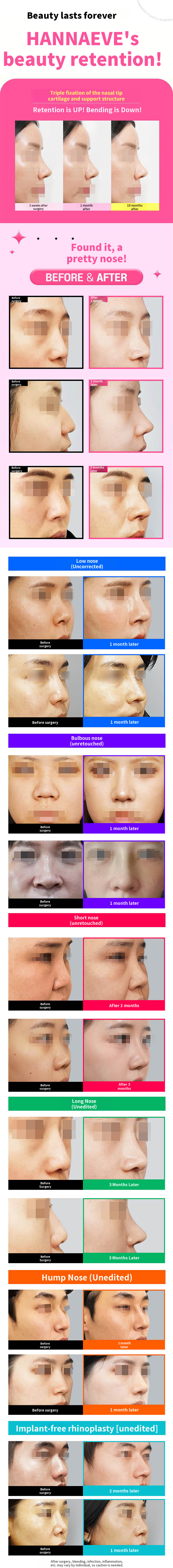 Customized Nose Tip Surgery for Higher Nose Bridge