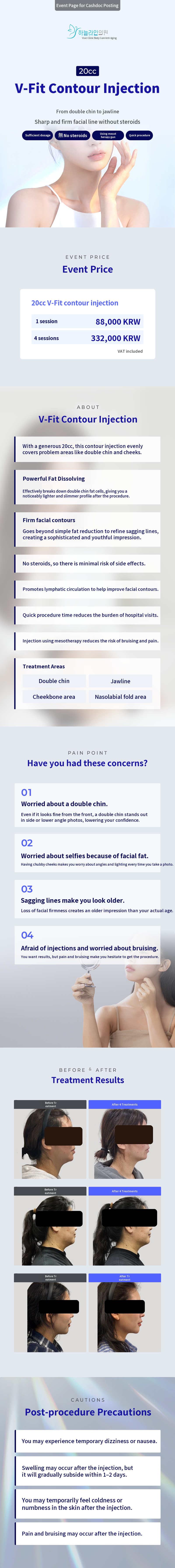 V-shape Contouring Injection