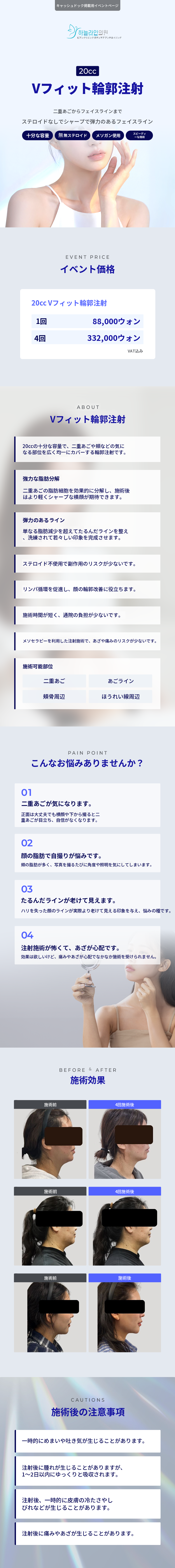 Vフィット輪郭注射