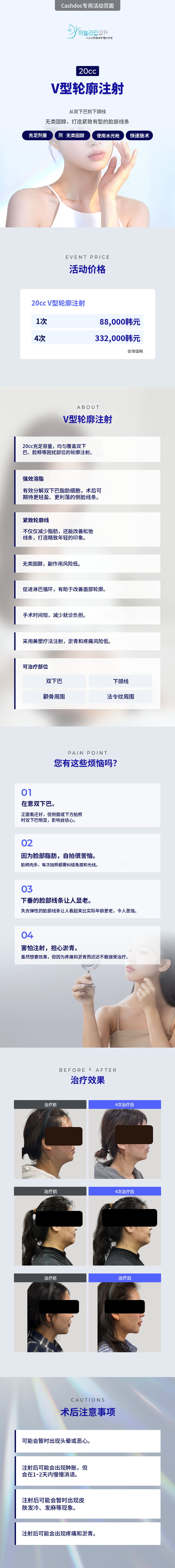 V型轮廓注射