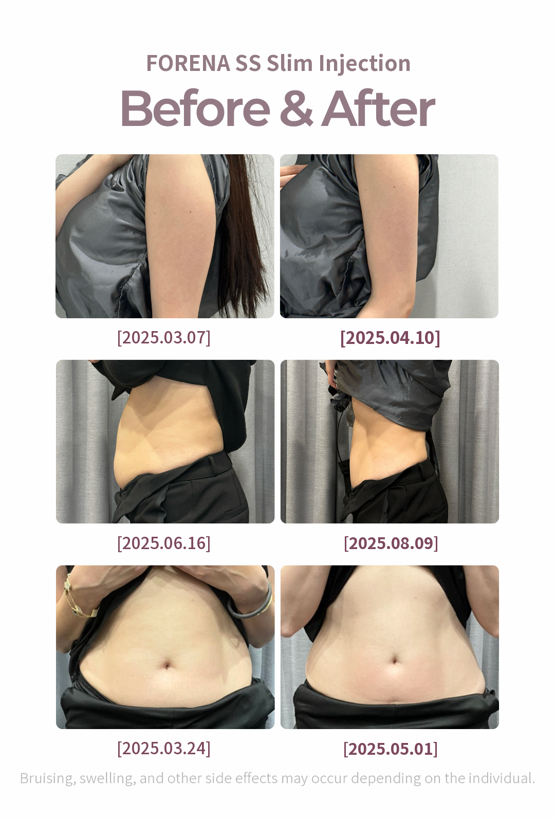 Hongdae Large Volume SS Slim Injection Fat Dissolving Injection_ Steroid Not Included
