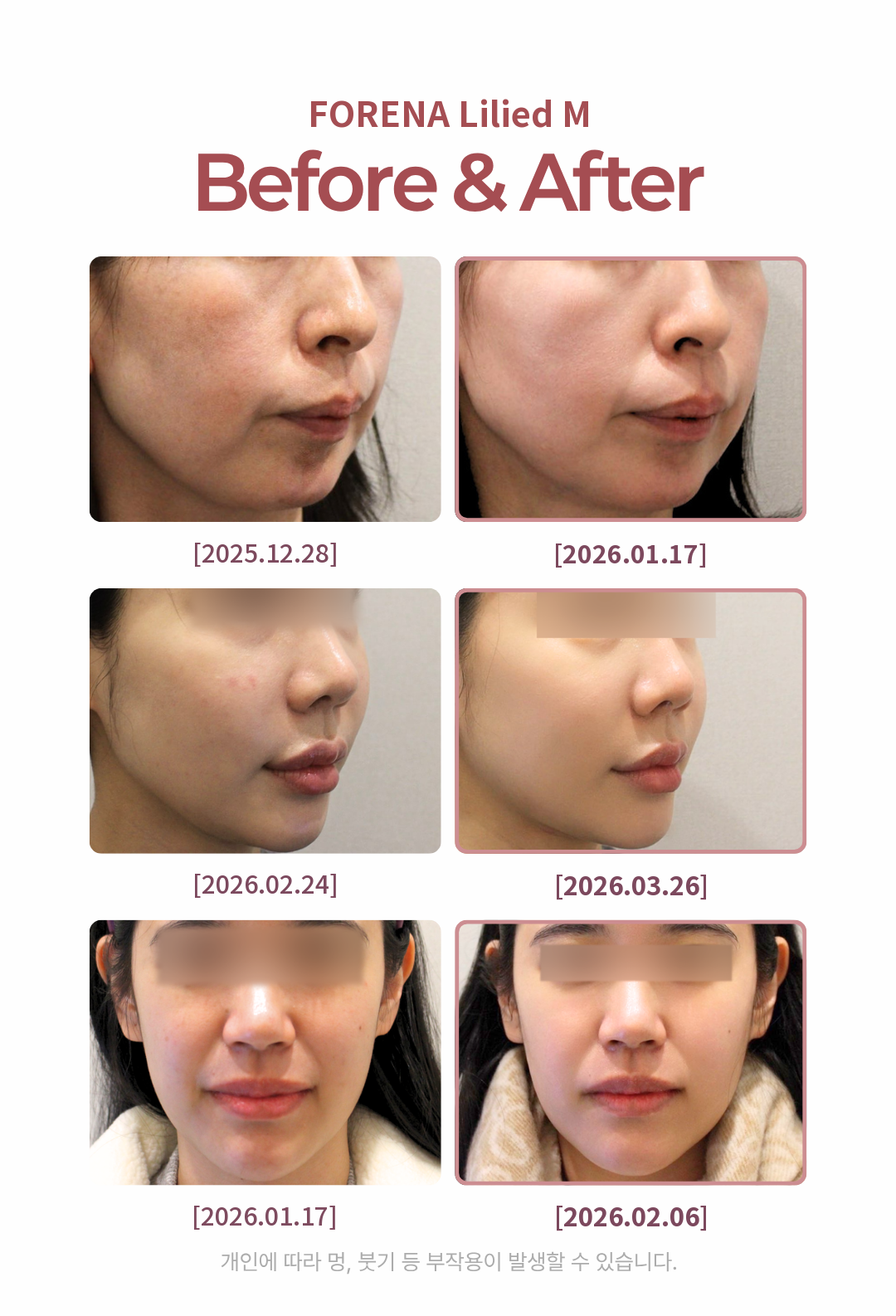 [Hongdae Foreina Clinic] LLLIAD M Glowing Injection 5cc