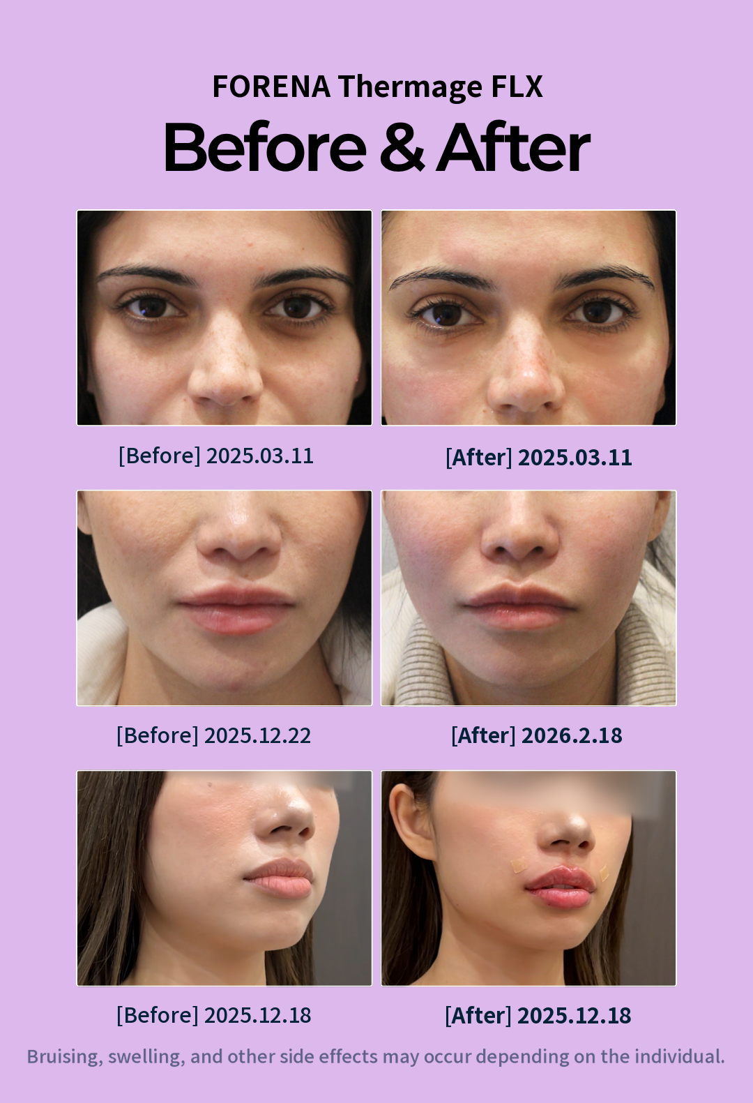 [Hongdae Foreana Clinic] Authentic Tip Customized Thermage FLX
