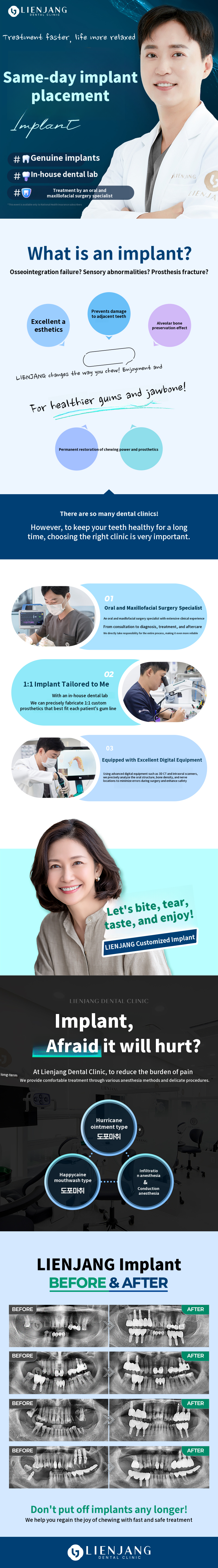 Chew, tear, taste, and enjoy! Rianjang Same-Day Dental Implants