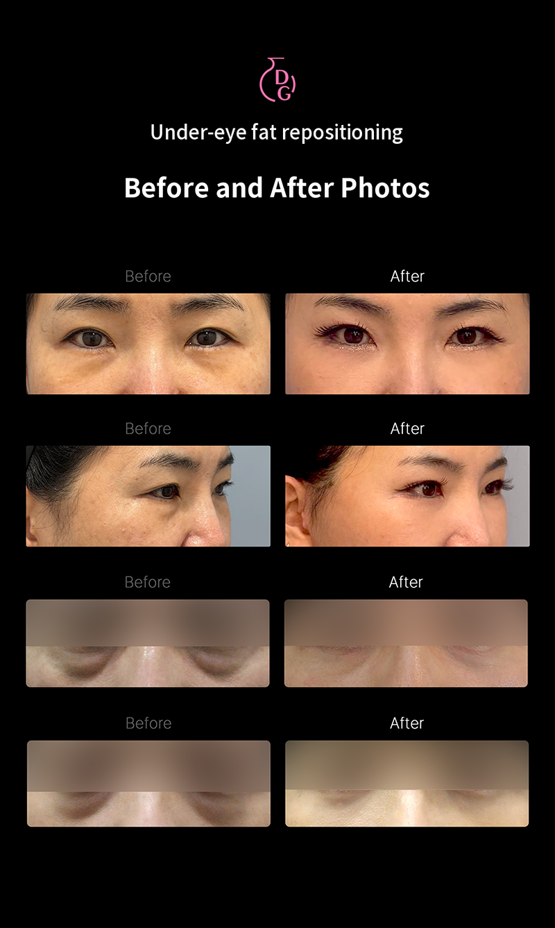 Real Special Offer! Under-Eye Fat Repositioning