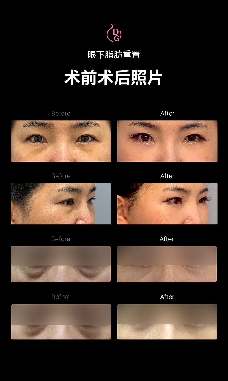 真正特惠！眼下脂肪重定位