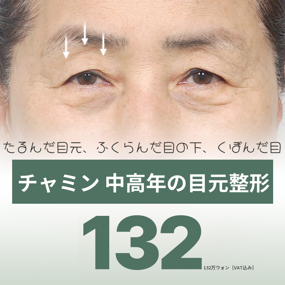 チャミン中年の目の整形