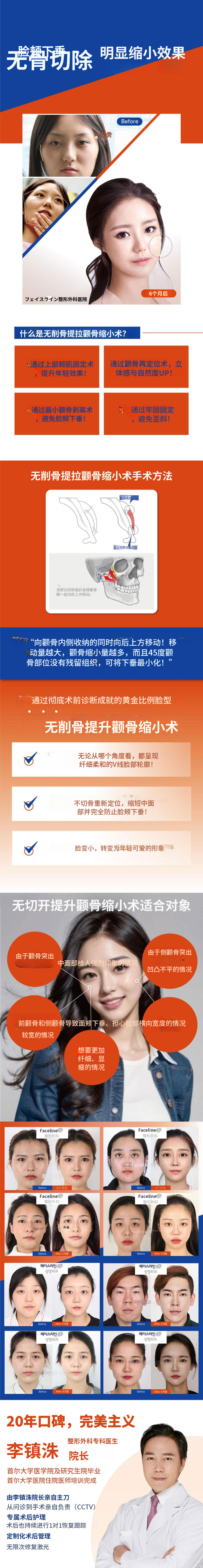 无切口提拉颊骨缩小术