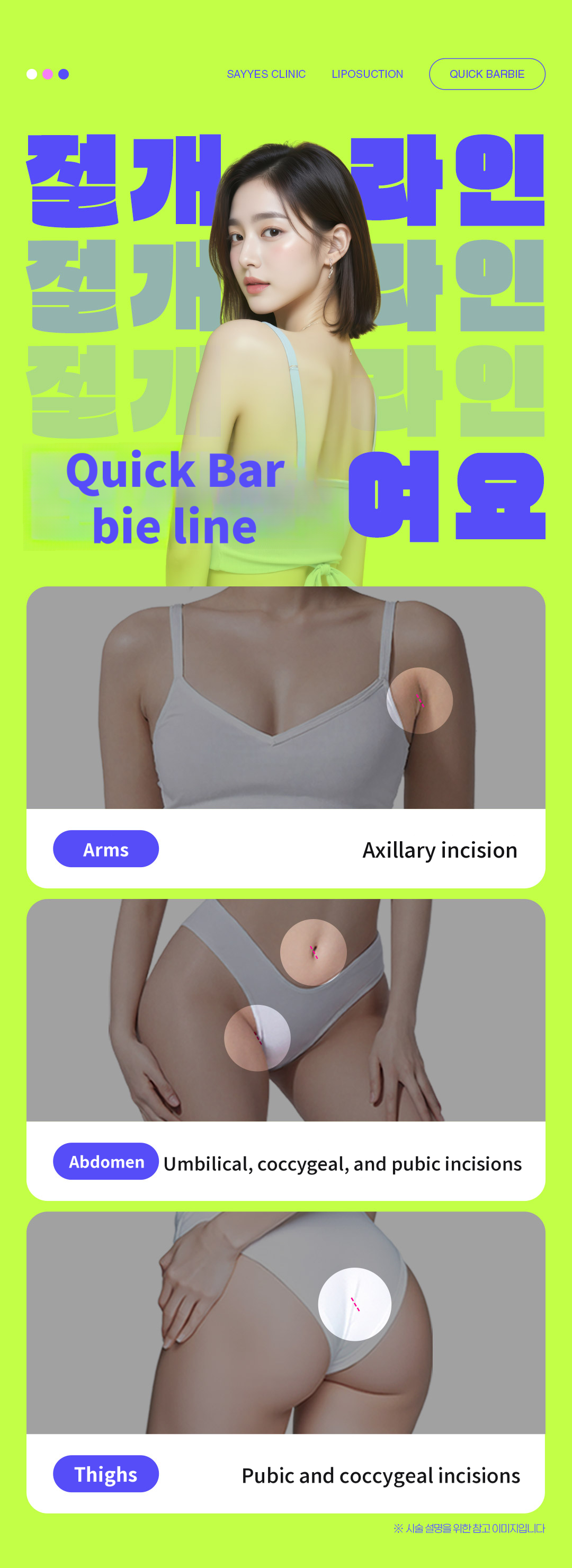 Large area liposuction, no compression garments needed, able to return to work the next day