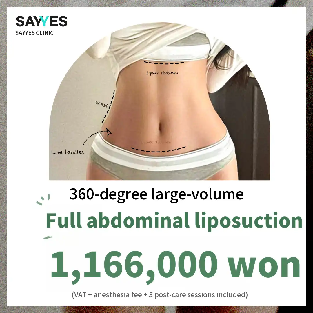 Large-Volume Full Abdomen Liposuction, Front Abdomen + Flanks + Love Handles Liposuction
