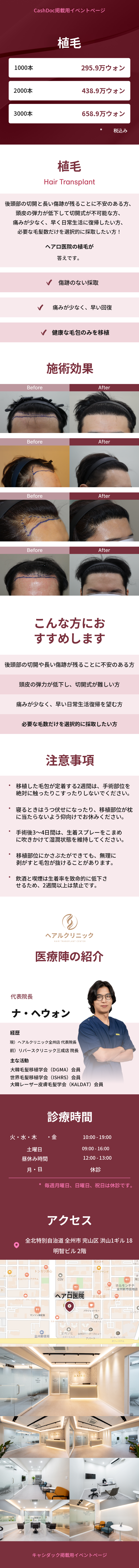非切開毛髪移植