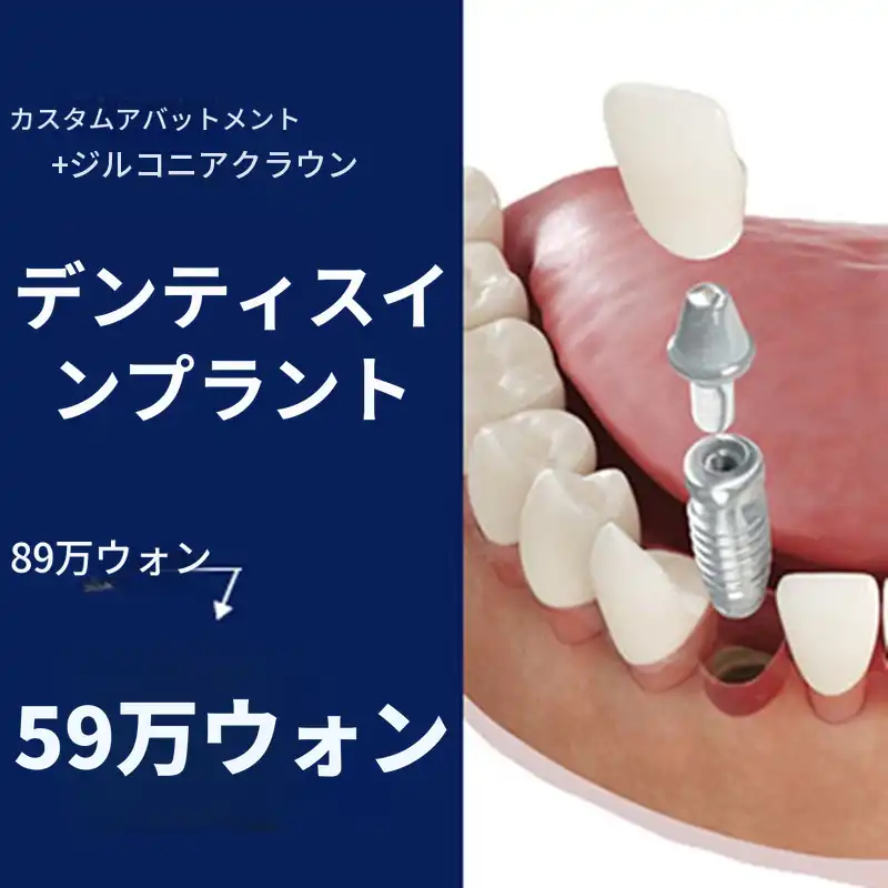 ソウル＆ユ歯科医院 正規品デンティスインプラント 59万円イベント - 専門医の診療 施術画像