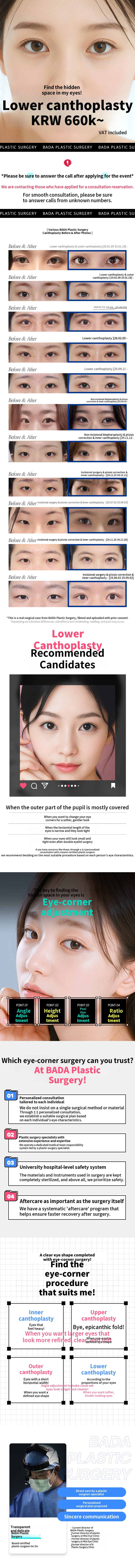 Eye Shape Expansion Surgery_Lower Expansion