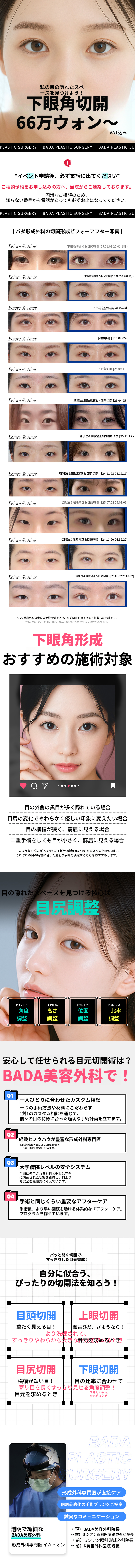 目の冴えを広げるための下眼瞼形成術