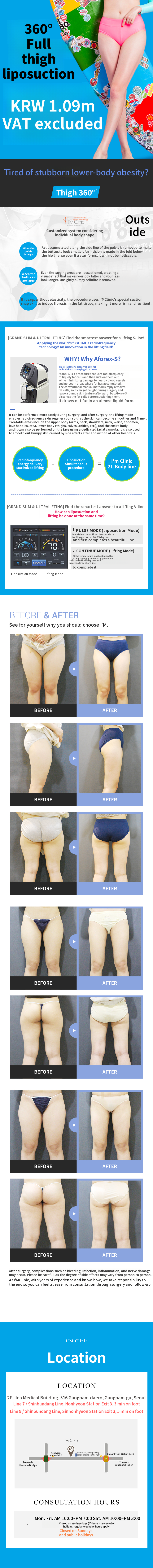 360-Degree Large Volume Liposuction of Thighs