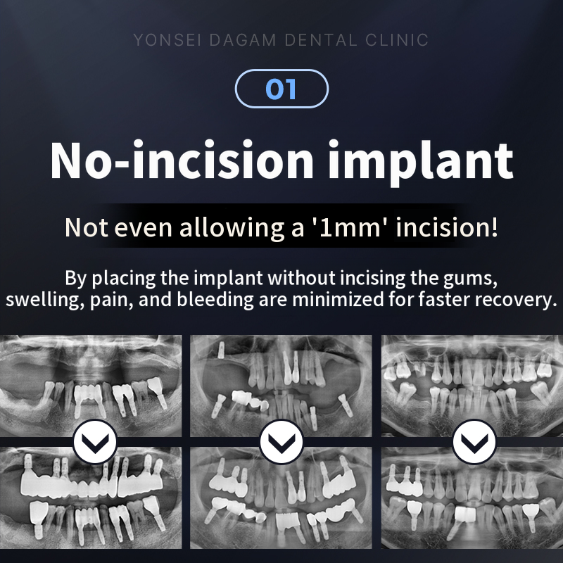 Non-incisional Implant, Osstem BA