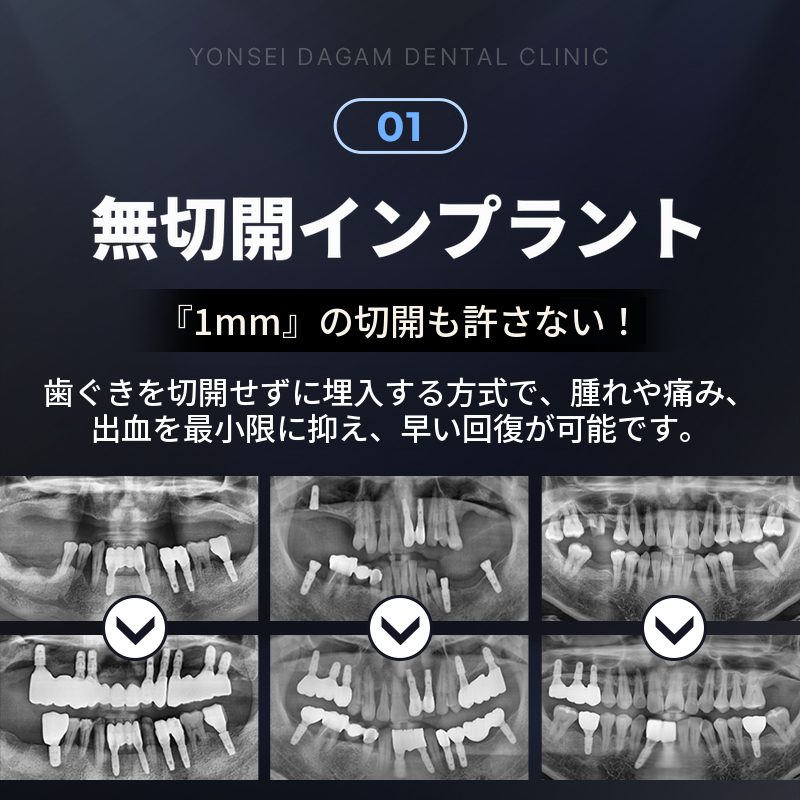 無切開インプラント、オステムBA
