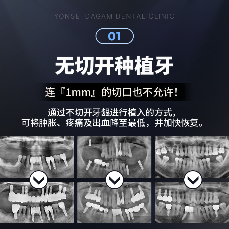 无切口植牙, 奥斯汀 BA
