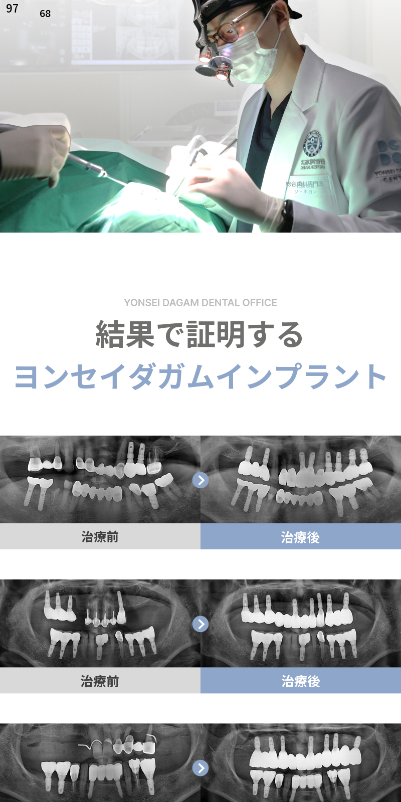 無切開インプラント、オステムBA