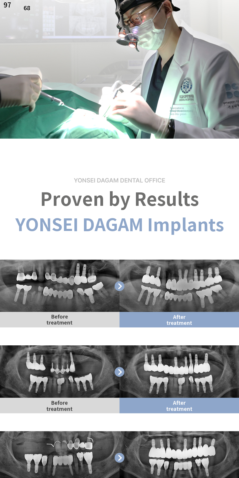 Flapless Dental Implants, Osstem SOI